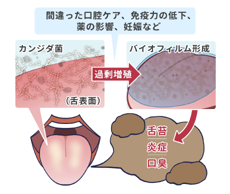 間違った口腔ケア、免疫力の低下、薬の影響、妊娠など